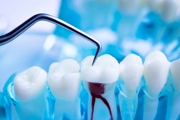 how long to do root canal