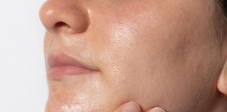 What Causes of Hyperpigmentation