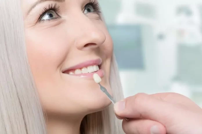 dental veneer services